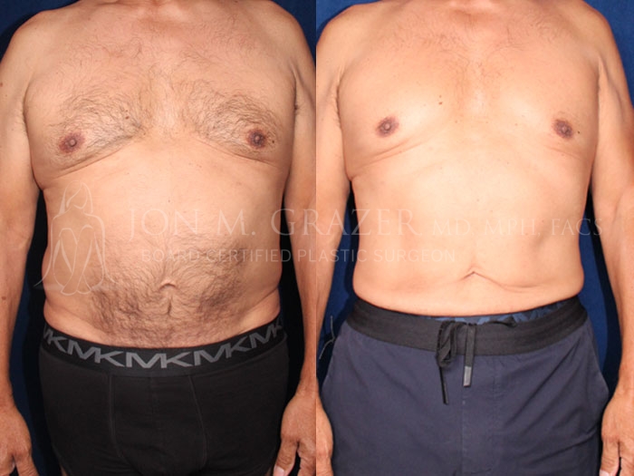 Before and After Image