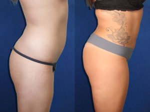 Before and After Image