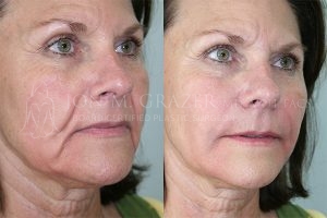 Before and After Image