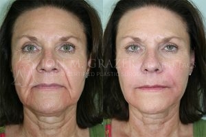 Before and After Image