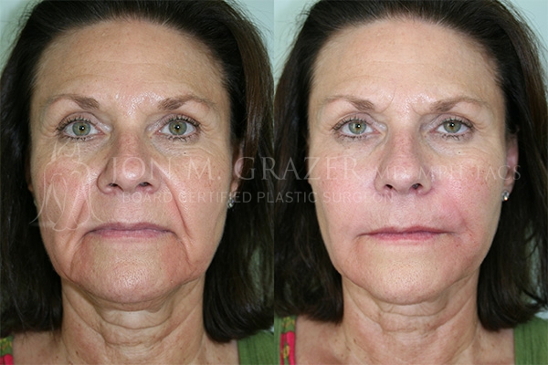 Before and After Image