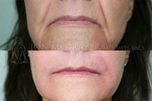 Before and After Image