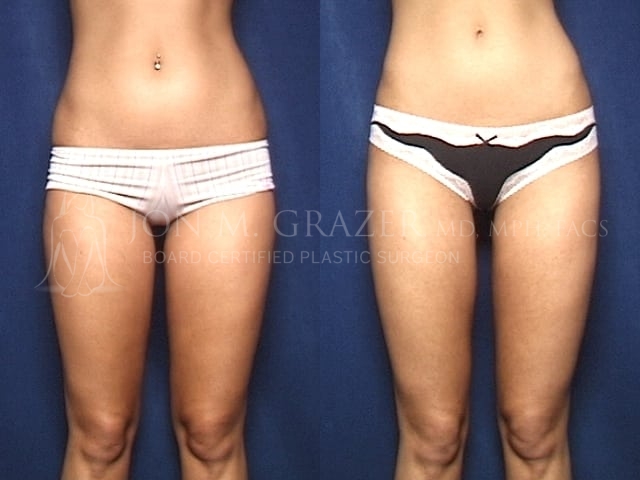 Before and After Image