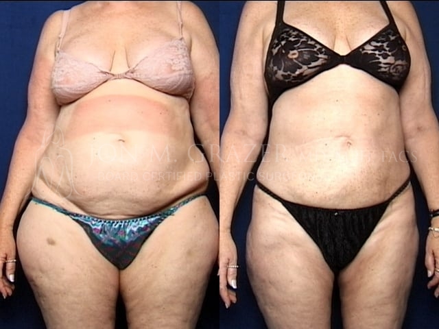 Before and After Image