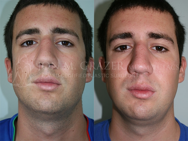 Before and After Image