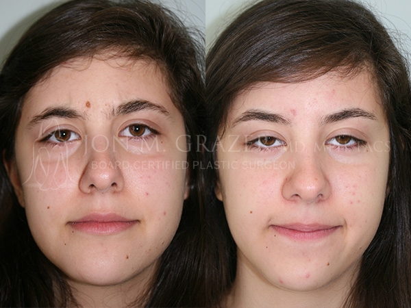 how to get rid of a birthmark mole at home