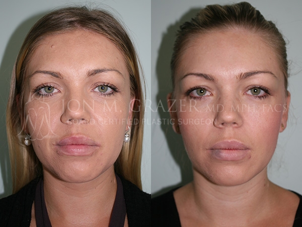 how to get rid of a birthmark mole at home