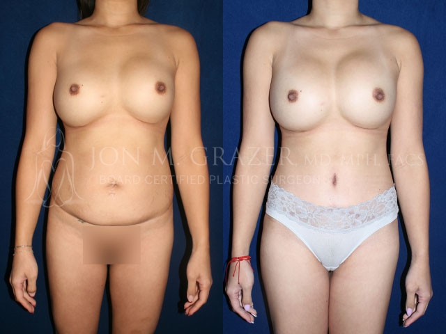 Before and After Image